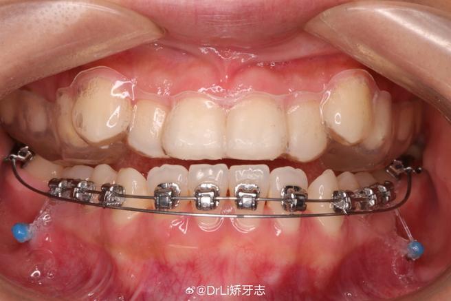 正畸牵引钩没带橡皮会有什么影响？-图1