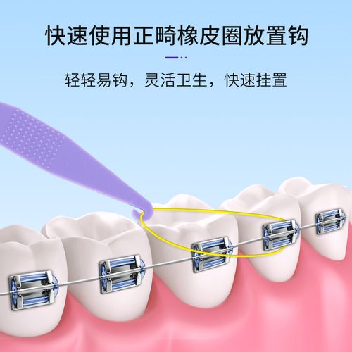 正畸牵引钩没带橡皮会有什么影响？-图2