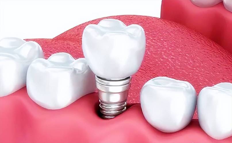 台牙牙科种牙-图3