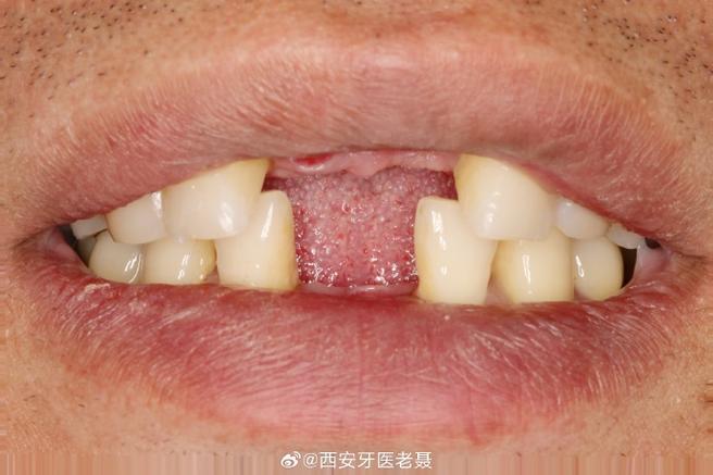 大门牙种牙6-图2