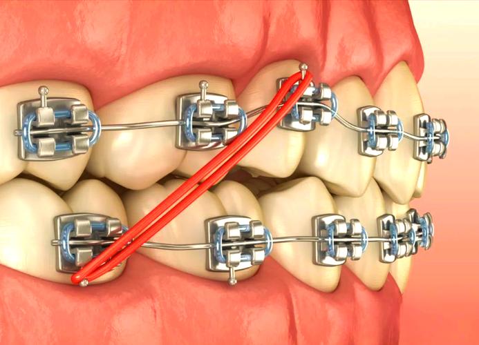 如何获取正畸橡皮圈图片？常见类型及正确使用方法指南-图2