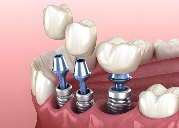 厦门牙科种牙-图2