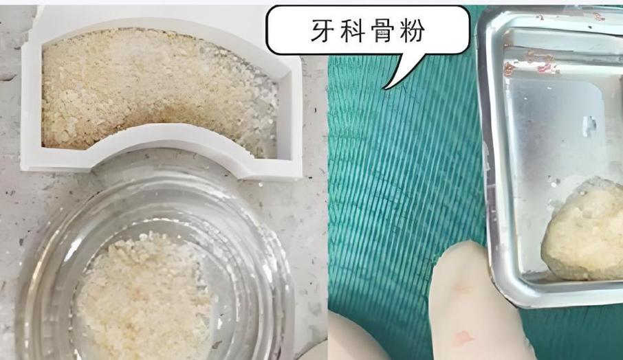 种牙骨膜是啥？种植牙中它到底起什么关键作用？-图1