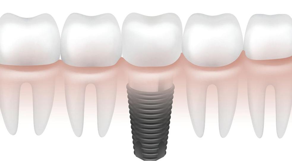 种牙骨膜是啥？种植牙中它到底起什么关键作用？-图3