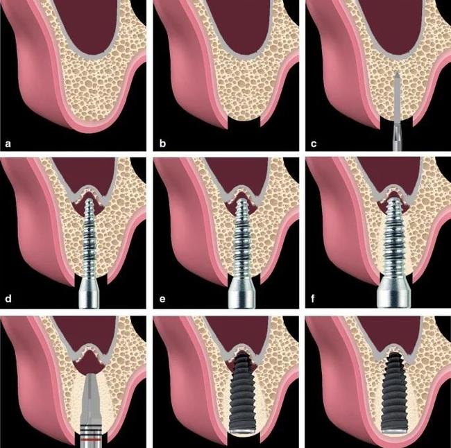 种牙内提手术-图1
