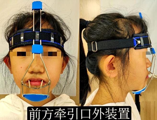 口外正畸牵引器图片能展示哪些关键结构?-图1 口外正畸牵引器图片能展示哪些关键结构?-图1