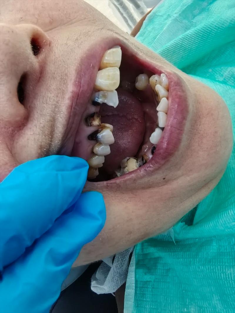 种牙后焦虑怎么办？原因分析与缓解指南-图1