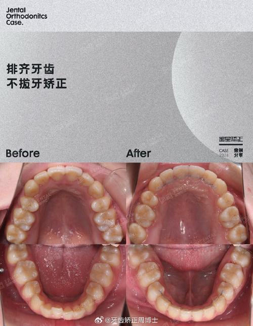 正畸中的垂直向跳跃-图2