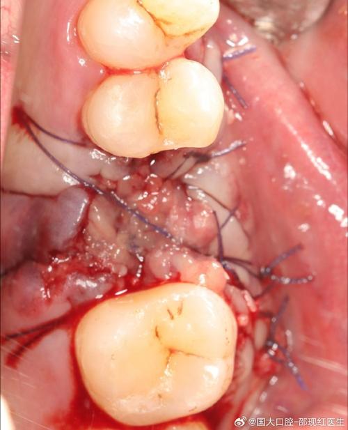 种牙后为何要缝线？对恢复有影响吗？-图3