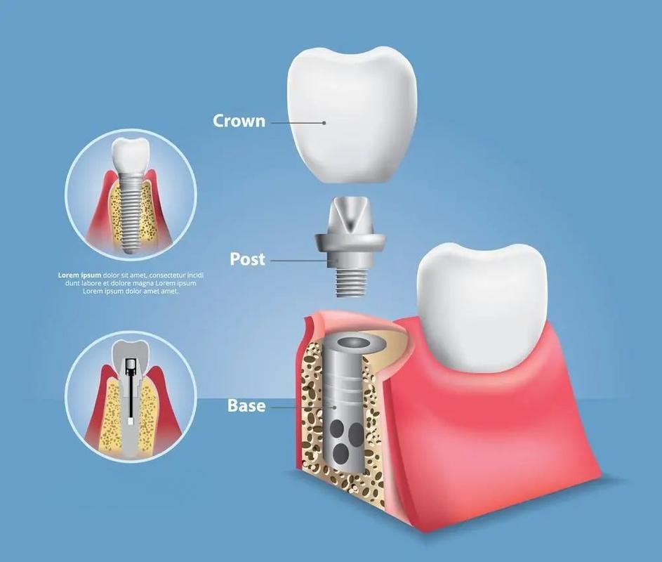 临时基台种牙-图3