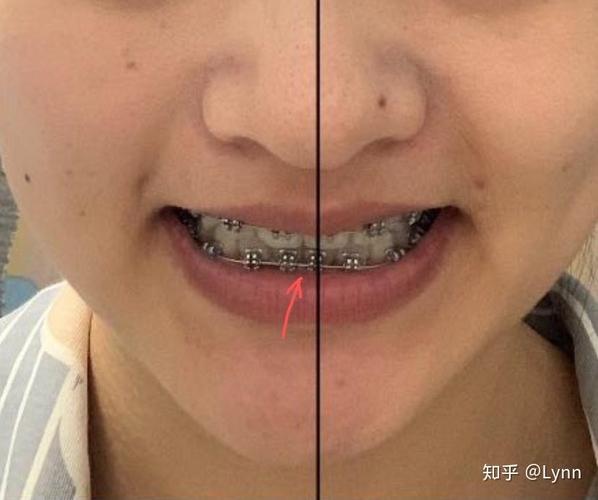 正畸中线偏移为何发生？如何有效矫正与预防？-图1