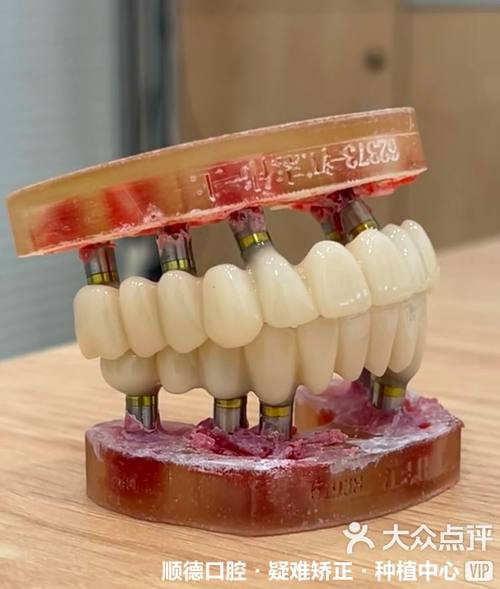 全口重新种牙-图3