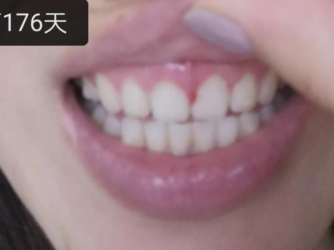 孕妇做正畸牙龈增生-图2