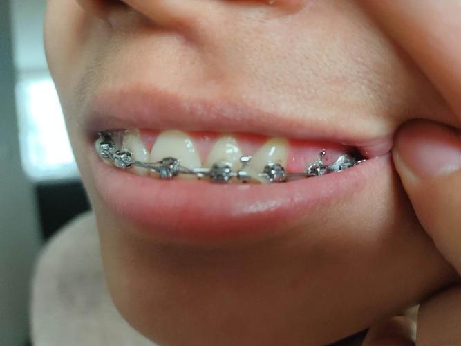 孕妇做正畸牙龈增生-图1