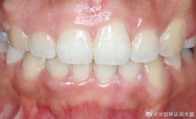 孕妇做正畸牙龈增生-图3