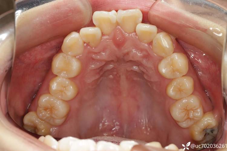 正畸拔牙上4 下5-图3