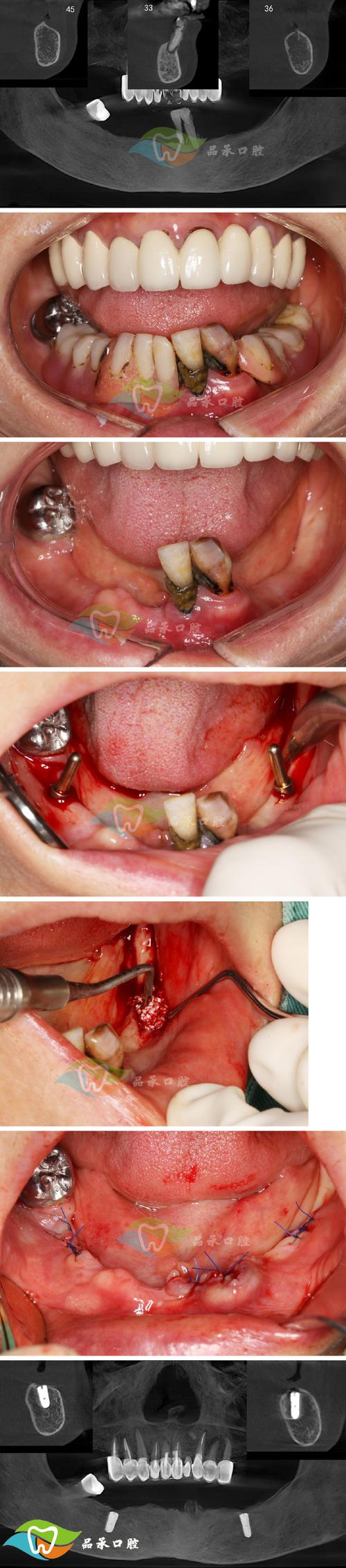 青岛李村种牙-图3