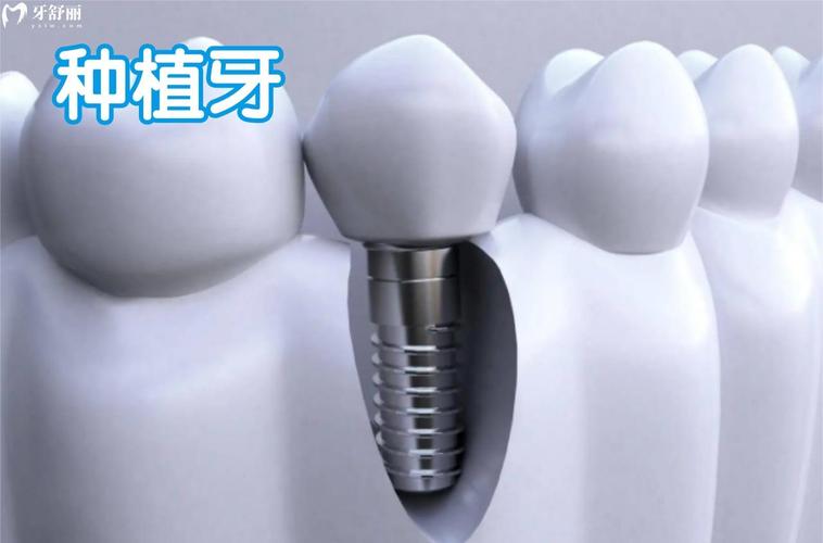 苏州私立种牙-图2