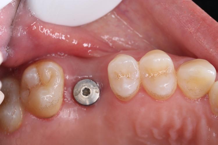 南京种牙修复怎么选？效果与价格靠谱吗？-图1