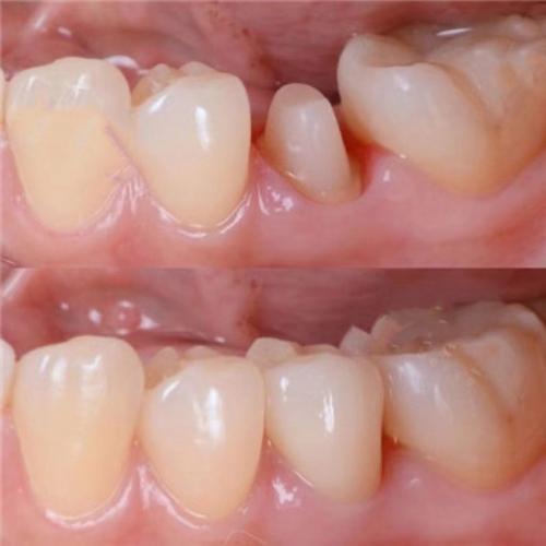 南京种牙修复怎么选？效果与价格靠谱吗？-图3