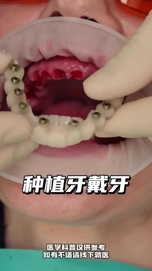 种牙视频感想-图2