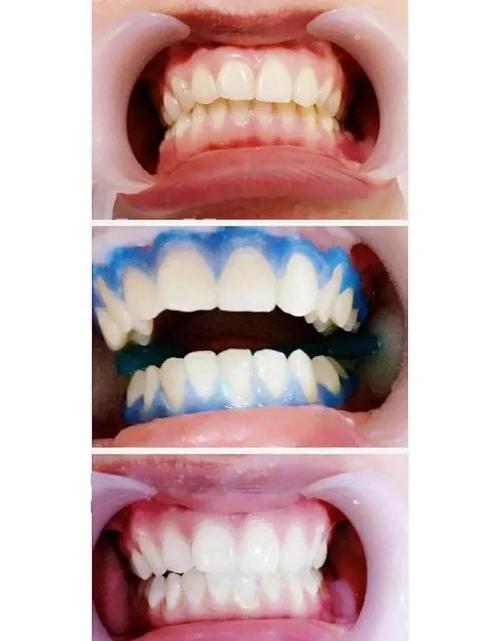 正畸后多久冷光美白-图3