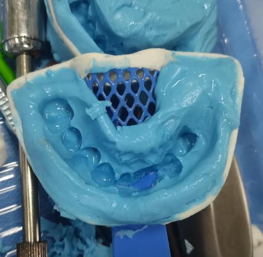 正畸取颌蜡，如何精准建立理想咬合关系？-图3