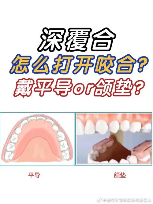 正畸平面导板作用图详解了哪些核心治疗功能？-图1