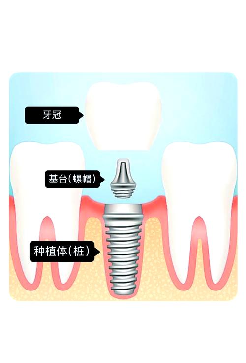 种牙经历 图-图2