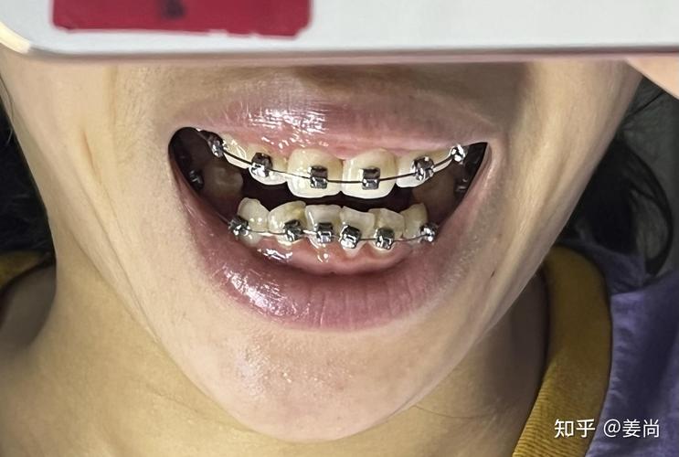 那所医院口腔正畸好-图3