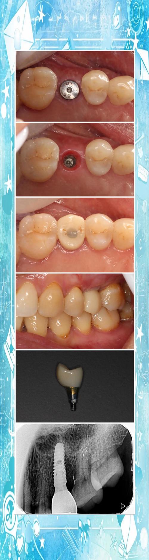 珠海惠民种牙-图1