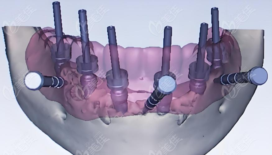 正畸数字化定位导板如何辅助精准牙齿定位与矫治？-图3