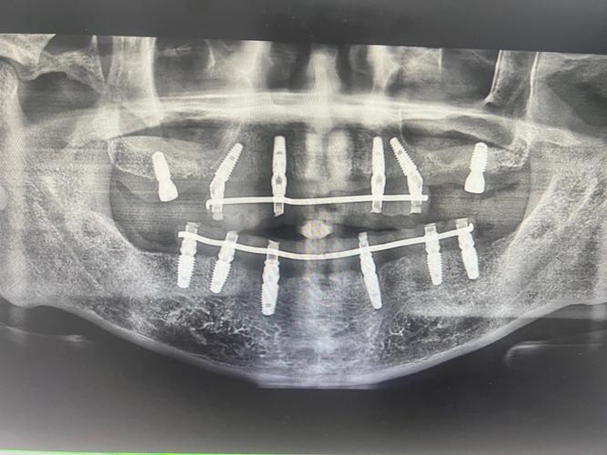 种牙骨头太薄，会影响种植效果吗？如何应对？-图3