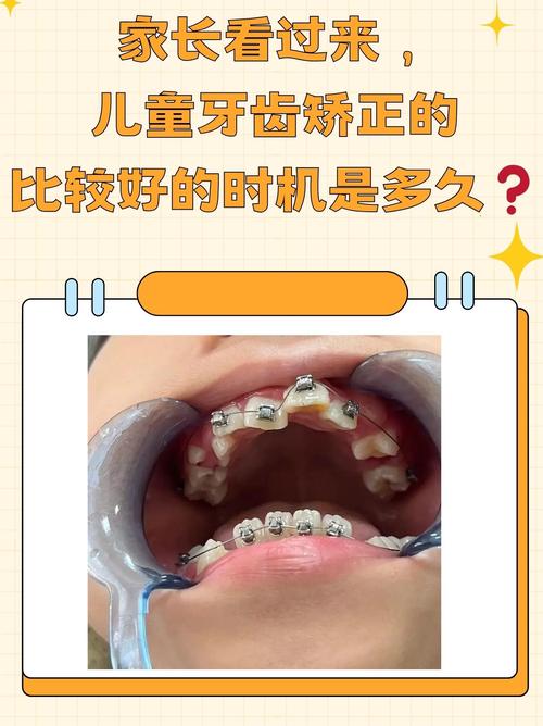 口腔正畸几岁比较好-图1