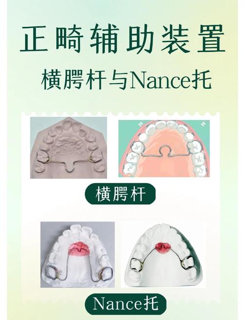 正畸横腭杆还有哪些其他名称或别称？-图2