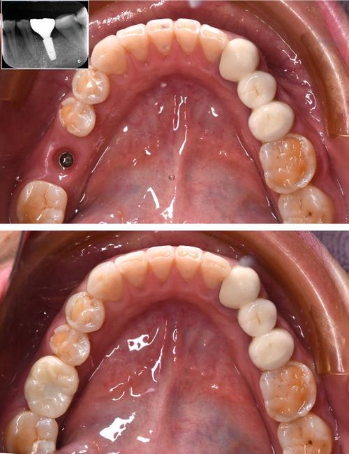 拔牙后种牙全过程是怎样的？痛感大吗？恢复期要注意哪些事项？-图1