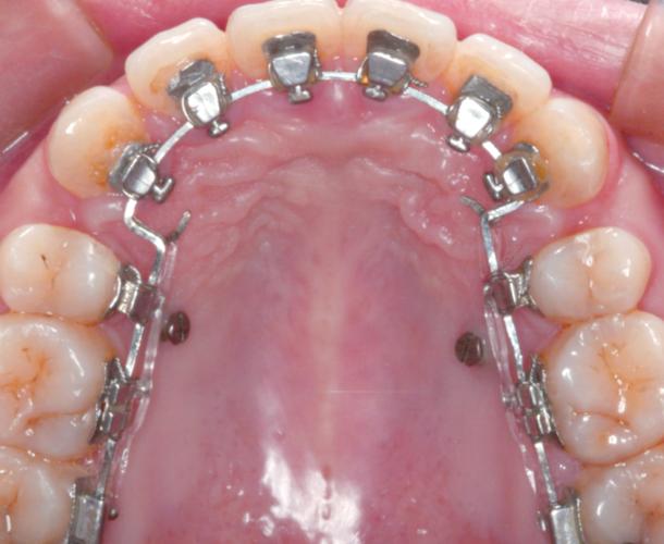 正畸埋伏牙牵引装置如何实现精准高效牵引矫治？-图1