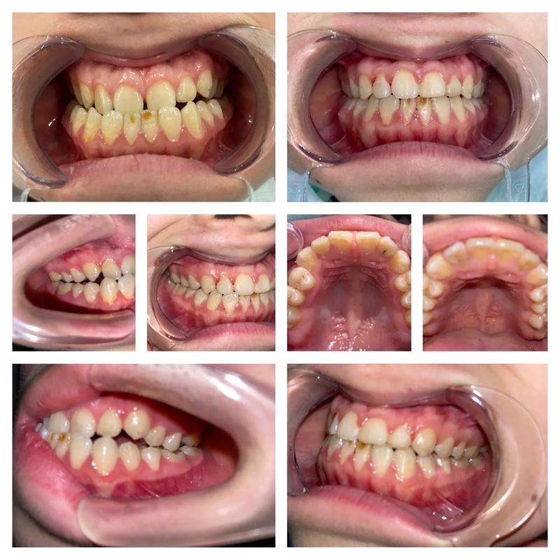 正畸时后牙会前移吗-图1