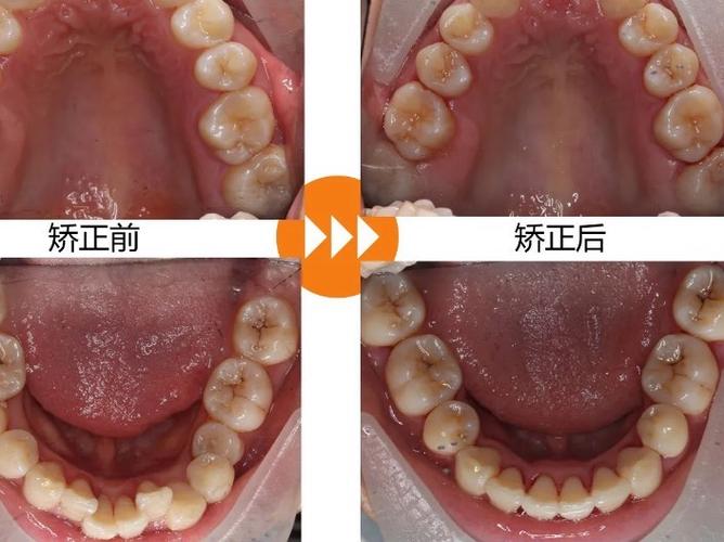 正畸时后牙会前移吗-图3