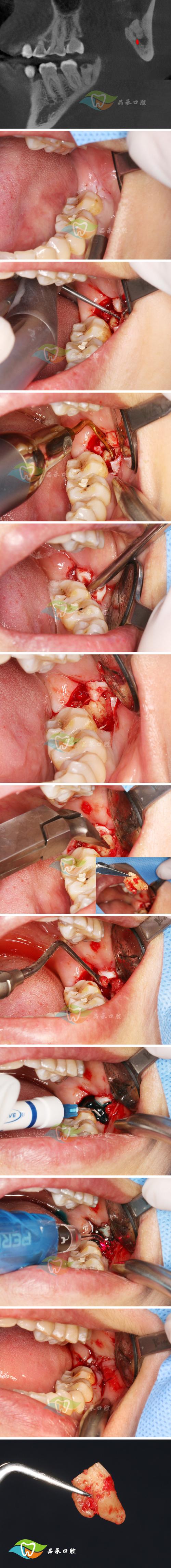 牙医种牙失败-图2