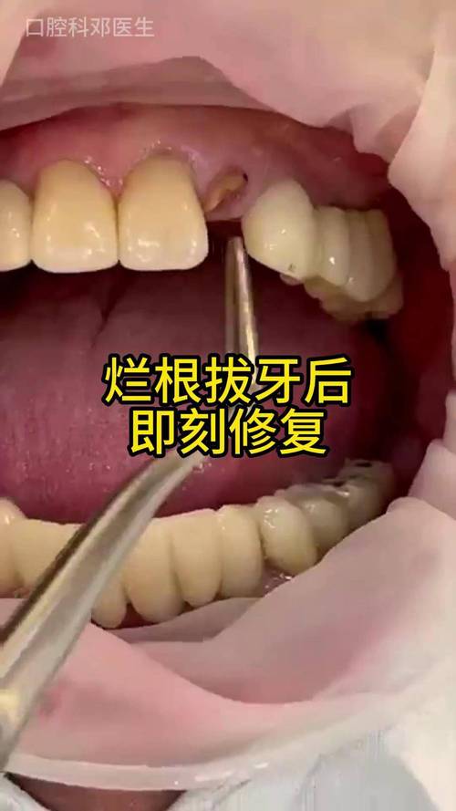 牙医种牙失败-图1