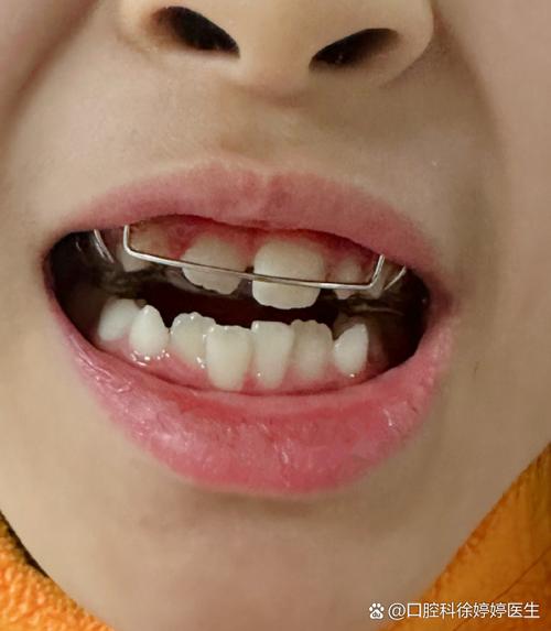 小孩正畸上门牙关闭-图1 小孩正畸上门牙关闭-图1