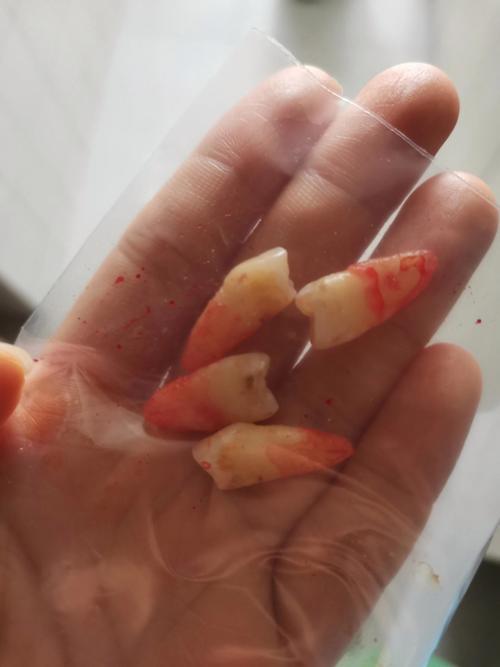 利用正畸把坏牙拔掉-图1