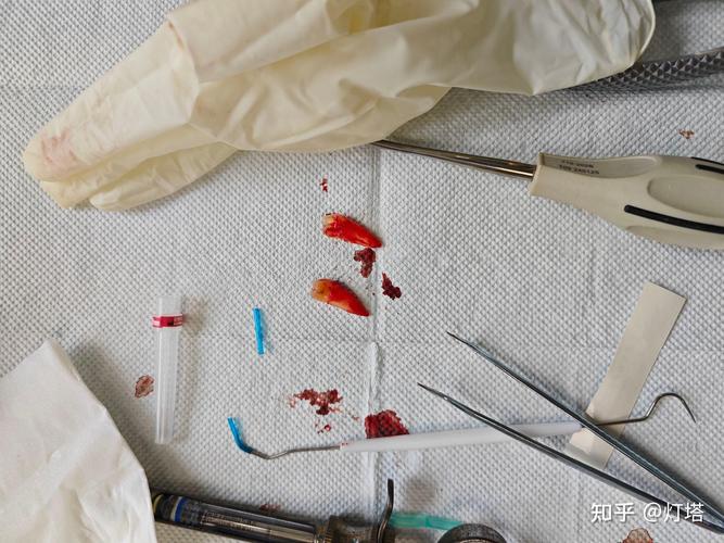 利用正畸把坏牙拔掉-图2