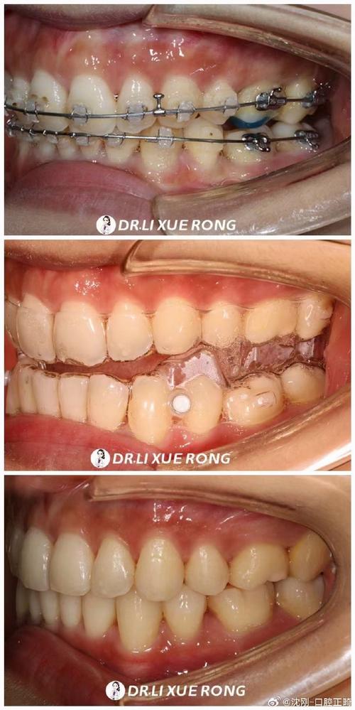 第二尖牙拔除后正畸-图3