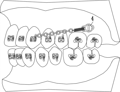 正畸弹簧的单侧受力-图3