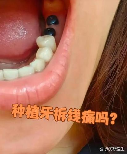 种牙后拆线时间、疼痛及护理注意事项有哪些？-图1