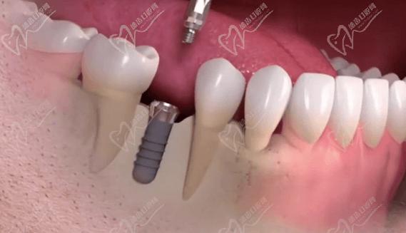 种牙后拆线时间、疼痛及护理注意事项有哪些？-图3