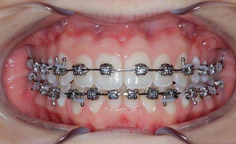 正畸期间托槽磨牙齿-图1