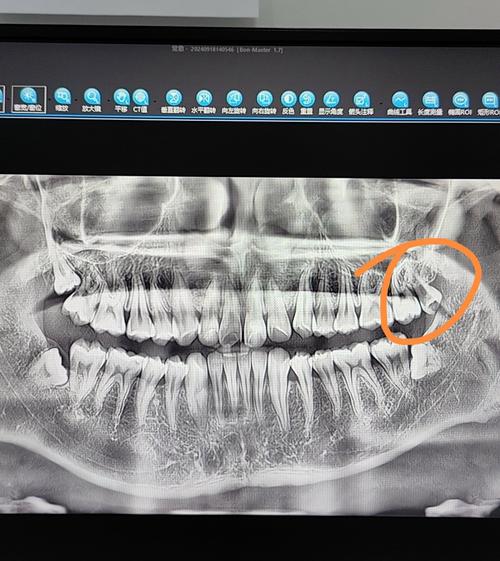 智齿拔除种牙-图3